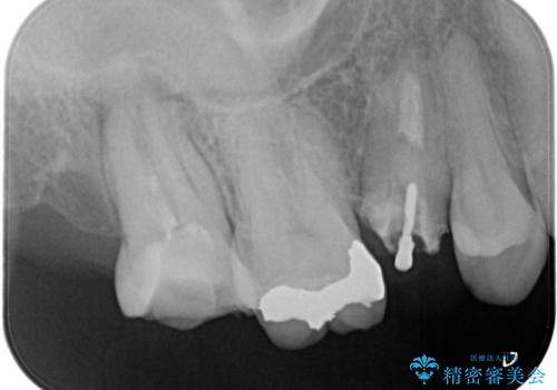 奥歯の根の病変も精密治療で解決の治療前