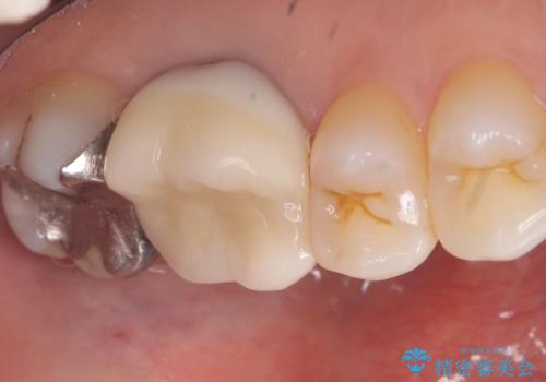 【セラミックインレー】口の中から金属を無くしたいの治療前
