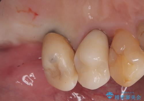 【インプラント】噛んだら痛みがあるの治療前