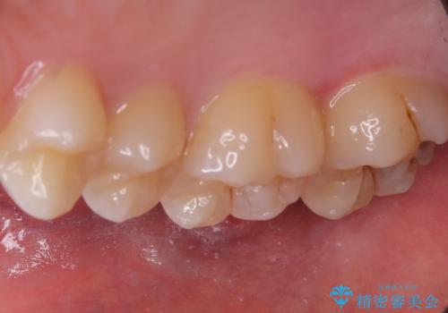 【セラミックインレー】歯科検診で虫歯が見つかったの治療前