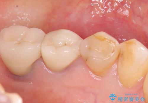 【セラミッククラウン】知覚過敏をどうにかしてほしいの治療前
