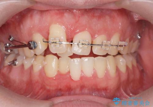 正中過剰埋伏歯で生じた前歯の審美障害 矯正治療での改善の治療中