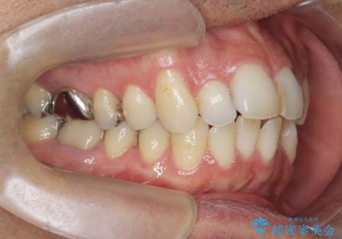 矯正と虫歯のセラミック治療 総合歯科治療の実践の治療前