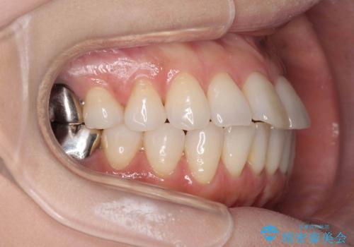 抜歯をせず前歯の角度を改善するマウスピース矯正治療の治療前