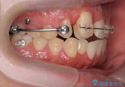 正中過剰埋伏歯で生じた前歯の審美障害 矯正治療での改善の治療中