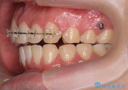 正中過剰埋伏歯で生じた前歯の審美障害 矯正治療での改善の治療中