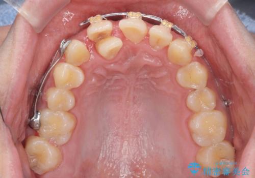 正中過剰埋伏歯で生じた前歯の審美障害 矯正治療での改善の治療中