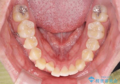 正中過剰埋伏歯で生じた前歯の審美障害 矯正治療での改善の治療中