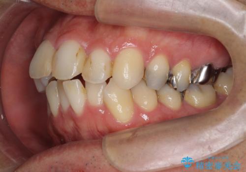 矯正と虫歯のセラミック治療 総合歯科治療の実践の治療前