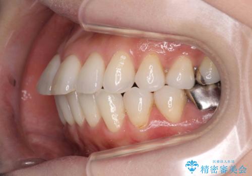 抜歯をせず前歯の角度を改善するマウスピース矯正治療の治療前