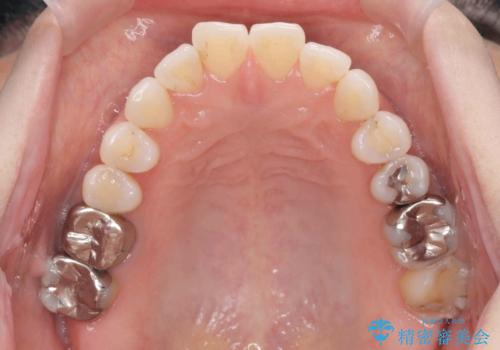 抜歯をせず前歯の角度を改善するマウスピース矯正治療の治療前