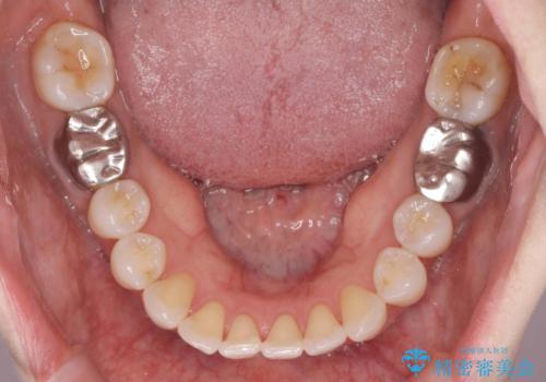 抜歯をせず前歯の角度を改善するマウスピース矯正治療の治療前