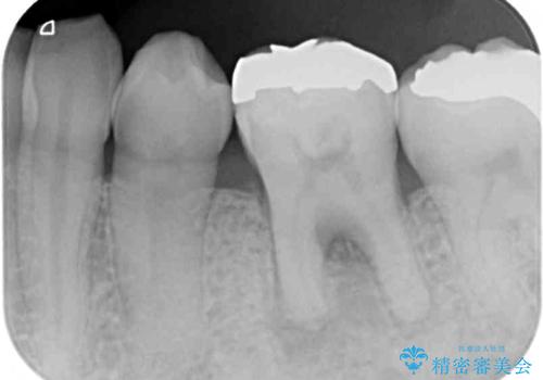 痛くて噛めない オールセラミッククラウンでのむし歯治療の治療前