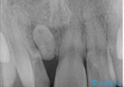 正中過剰埋伏歯で生じた前歯の審美障害 矯正治療での改善の治療前