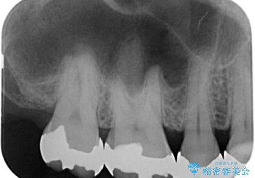 銀歯からセラミックへの治療前