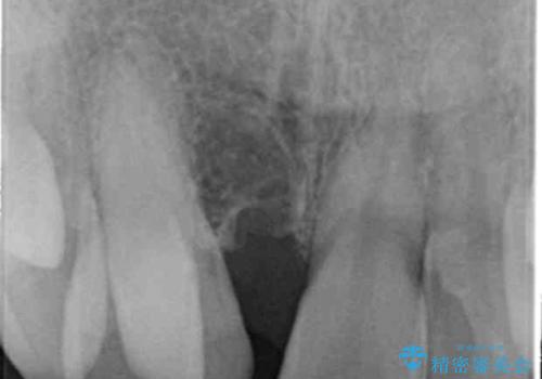 正中過剰埋伏歯で生じた前歯の審美障害 矯正治療での改善の治療前