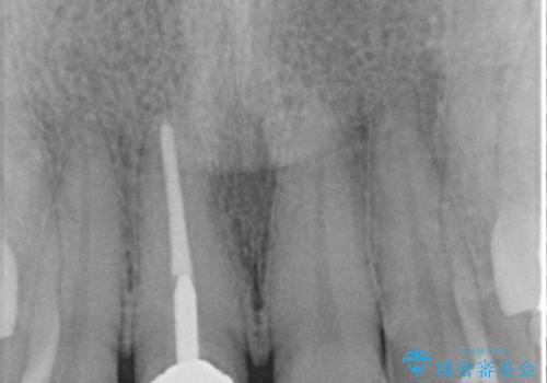 不自然な色彩の前歯 オールセラミッククラウンで自然な口元にの治療前