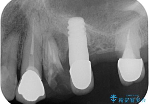 抜歯が必要な歯をインプラントに 短期間インプラント治療の治療前