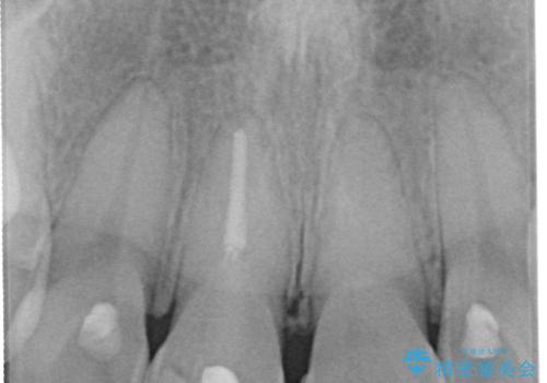 神経を取って変色した歯 オールセラミッククラウンで綺麗に仕上げるの治療前