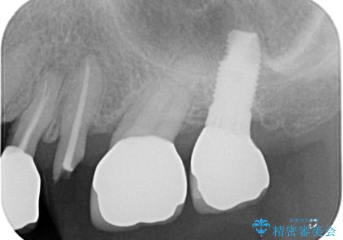 破折によりクラウンの外れてしまった奥歯 抜歯即時埋入で短期間インプラント治療の治療前