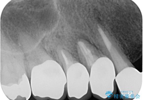 歯肉から膿が出る 破折した奥歯の抜歯即時埋入インプラントの治療前