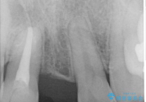 転んで折れてしまった前歯 インプラント補綴治療の治療前