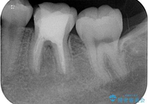 神経を取って変色した歯 オールセラミッククラウンで綺麗に仕上げるの治療前