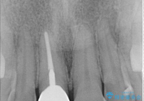 不自然な色彩の前歯 オールセラミッククラウンで自然な口元にの治療後