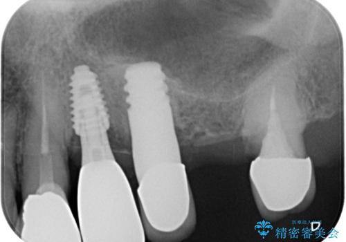 抜歯が必要な歯をインプラントに 短期間インプラント治療の治療後
