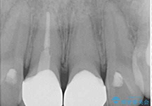 神経を取って変色した歯 オールセラミッククラウンで綺麗に仕上げるの治療後