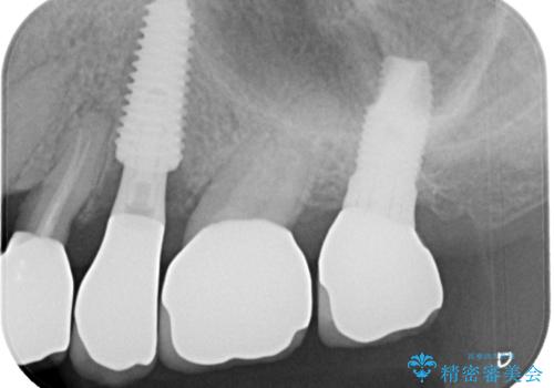 破折によりクラウンの外れてしまった奥歯 抜歯即時埋入で短期間インプラント治療の治療後