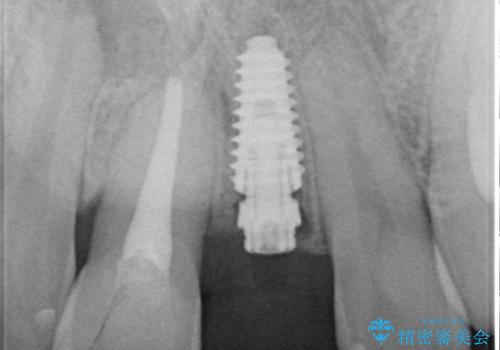 転んで折れてしまった前歯 インプラント補綴治療の治療中