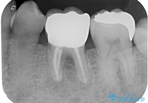 痛くて噛めない オールセラミッククラウンでのむし歯治療の治療後