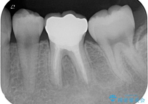 神経を取って変色した歯 オールセラミッククラウンで綺麗に仕上げるの治療後