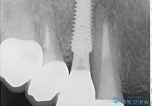 歯肉から膿が出る 破折した奥歯の抜歯即時埋入インプラントの治療後