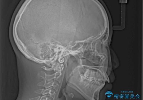 飛び出した前歯 インビザラインを用いた抜歯矯正治療の治療前