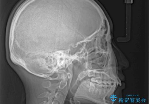 出っ歯を治したい　ワイヤー装置での抜歯矯正の治療前