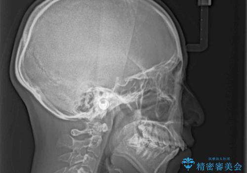 【モニター】とがった口元を抜歯して改善　ワイヤー装置の矯正治療の治療前