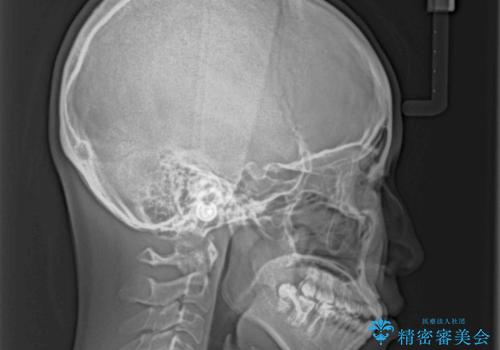 急速拡大装置 狭い骨幅を拡大した上で、口元の突出感を改善する抜歯矯正治療の治療前