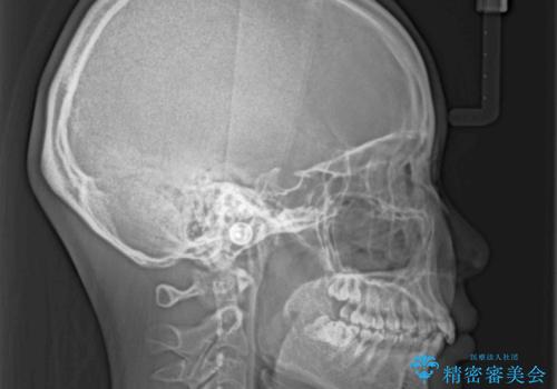 上の前歯が下唇に引っかかる　口元を引っ込めすぎない抜歯矯正治療の治療前