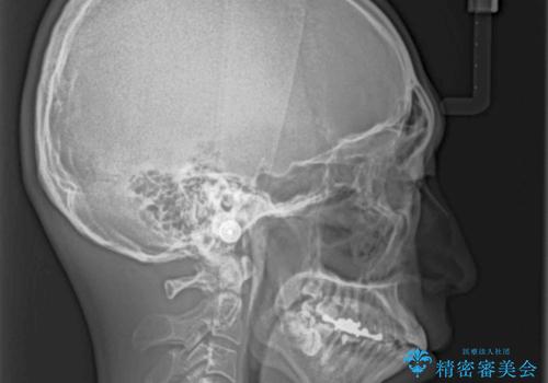 口元の突出感を改善!目立ちにくいワイヤー矯正で自信を持てる自然な横顔にの治療前