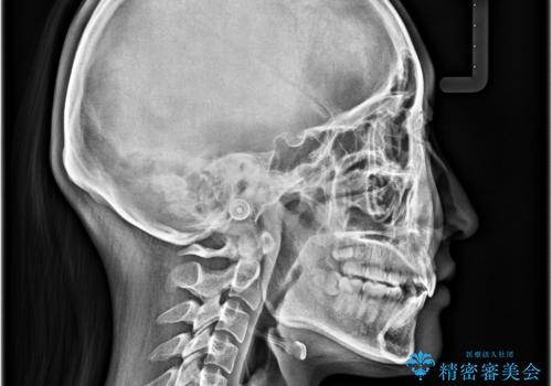 出っ歯を治したい ワイヤー装置での抜歯矯正の治療後