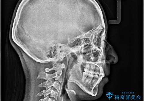 【モニター】とがった口元を抜歯して改善 ワイヤー装置の矯正治療の治療後