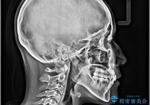 急速拡大装置 狭い骨幅を拡大した上で、口元の突出感を改善する抜歯矯正治療の治療後