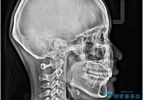 上の前歯が下唇に引っかかる 口元を引っ込めすぎない抜歯矯正治療の治療後