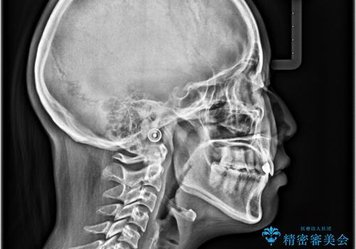 飛び出した前歯　インビザラインを用いた抜歯矯正治療の治療後