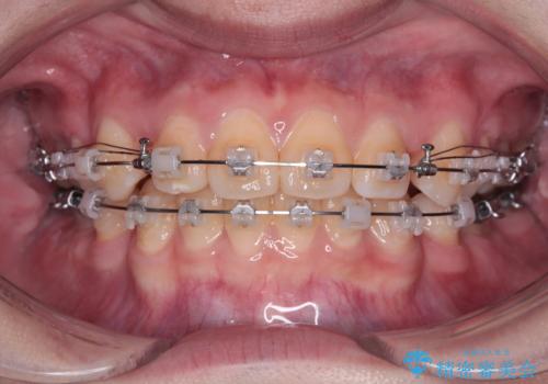転勤でも安心して治療継続 抜歯スペース閉鎖と深い噛み合わせ改善のワイヤー矯正の治療中