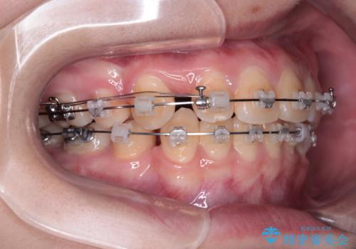 転勤でも安心して治療継続 抜歯スペース閉鎖と深い噛み合わせ改善のワイヤー矯正の治療中