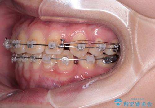 転勤でも安心して治療継続 抜歯スペース閉鎖と深い噛み合わせ改善のワイヤー矯正の治療中