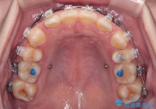 転勤でも安心して治療継続 抜歯スペース閉鎖と深い噛み合わせ改善のワイヤー矯正の治療中